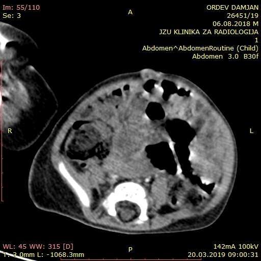 CT scan of abdomen